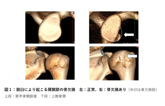 肩関節　骨欠損　肩関節脱臼
